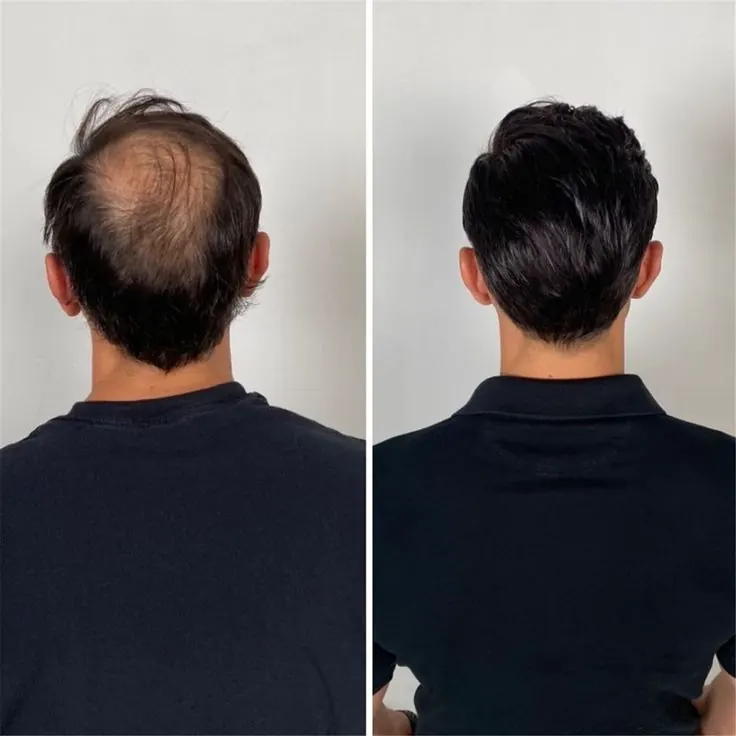 Hair Patch treatment at Kira Exotica, a beauty salon in Indore